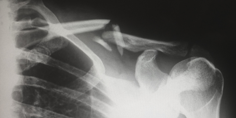 kontuzja, zdjęcie: harlie-raethel@unsplash.com, CC0